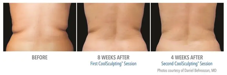 How Much Is CoolSculpting in Houston